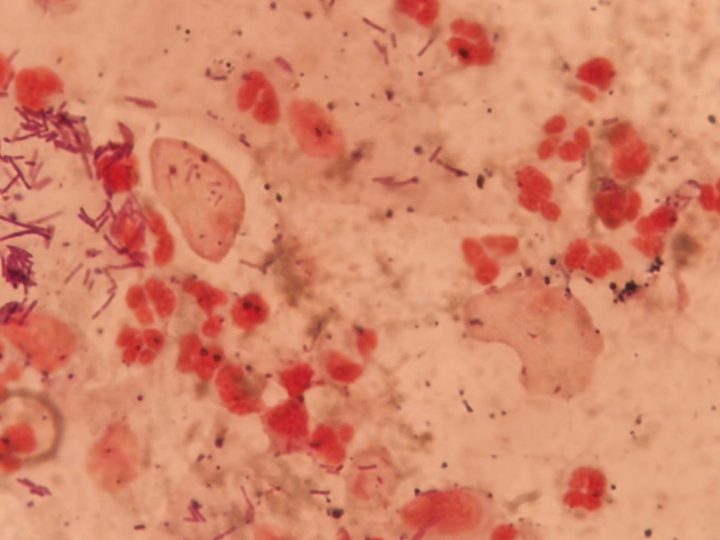 Discharge smear: trichomonads among segmented neutrophils and lactobacilli