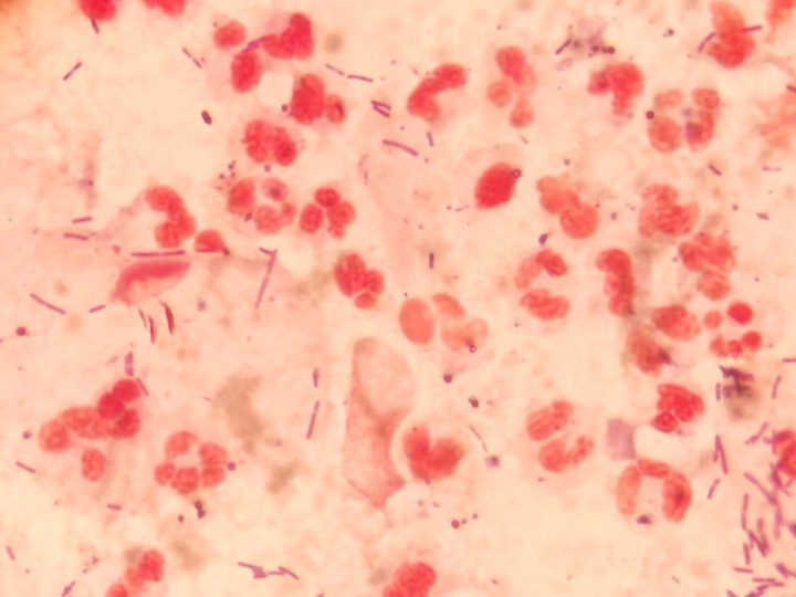 Smear microscopy: pronounced leukocyte reaction and long rod-shaped flora