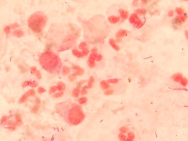 Stained discharge smear: round trichomonad trophozoites next to neutrophils