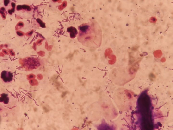 Female discharge smear: epithelial cells, rod-shaped microflora, and leukocytes