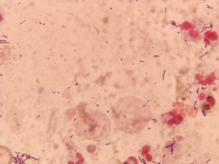 Smear preparation: pale round bodies of trichomonads against a background of massive bacillary flora