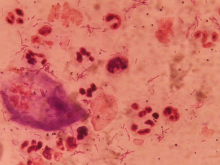 Microscopy of stained smear: neutrophils, rod-shaped flora, and a trichomonad trophozoite
