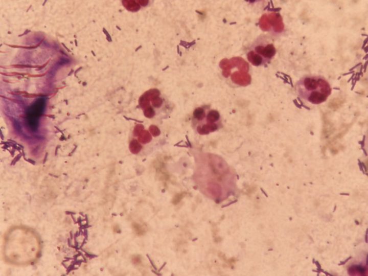 Smear for flora: group of segmented neutrophils, bacteria, and a trichomonad