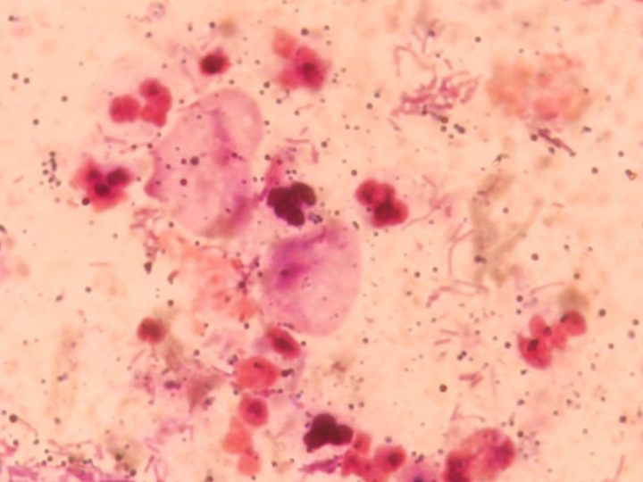 Smear microscopy: pronounced inflammatory reaction with leukocytes and trichomonads