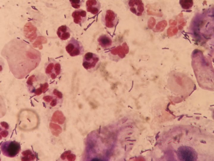 Stained discharge preparation: squamous epithelial cells and clusters of neutrophils