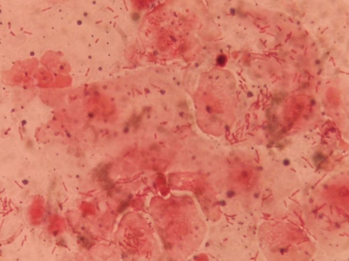 Discharge smear: sheets of epithelial cells with abundant rod-shaped flora and leukocytes