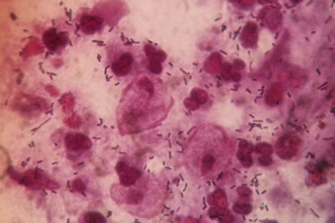 Trichomonads in Urine and Vaginal Discharge of a Pregnant Woman
