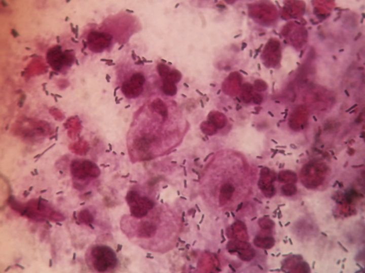 Discharge smear: trichomonads among leukocytes