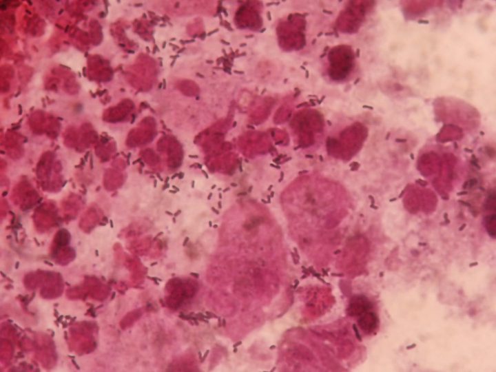 Trichomonads and leukocytes in a vaginal discharge smear