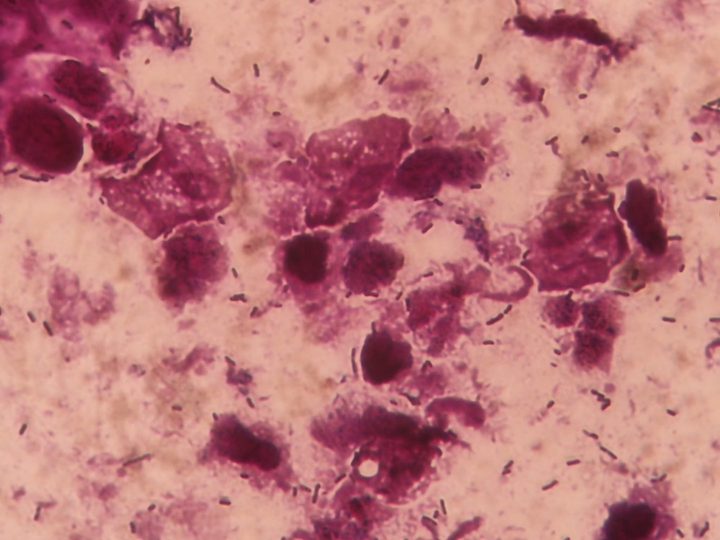 Trichomonads and exfoliated epithelium, another field