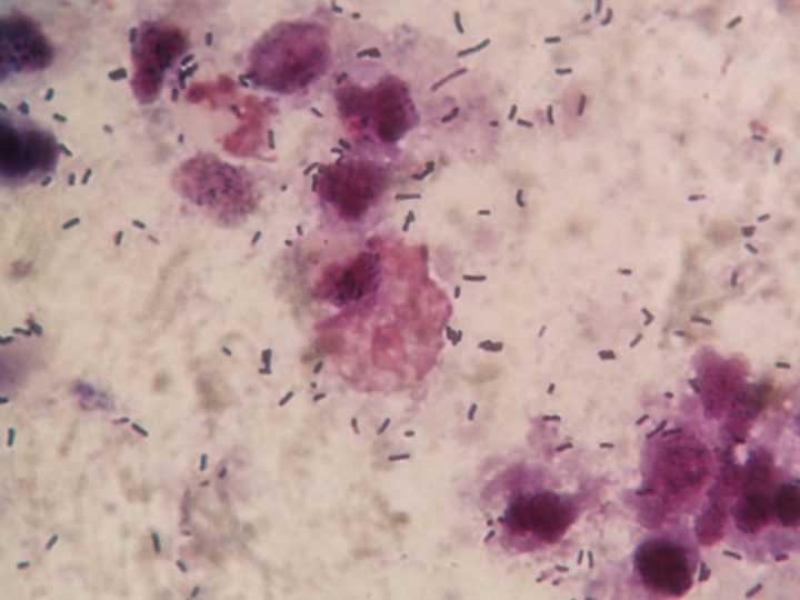 Trichomonads and rod-shaped bacteria in the smear