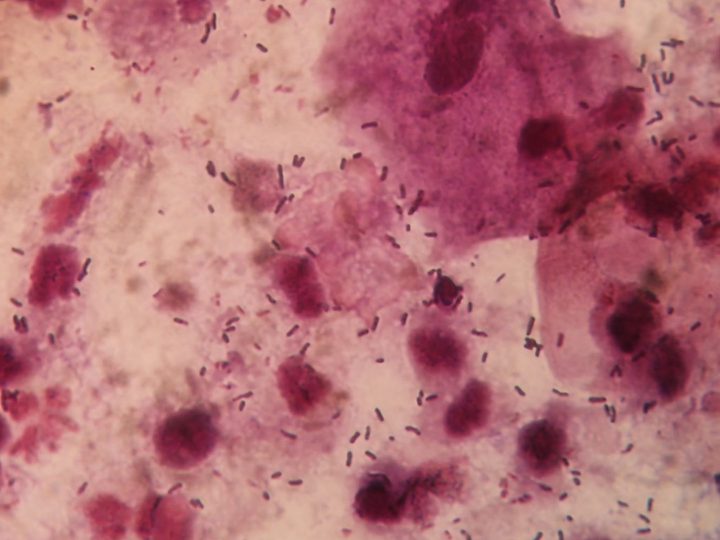 Squamous epithelium, leukocytes and trichomonads in the smear
