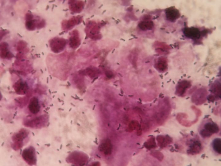 A cluster of trichomonads and leukocytes in the smear