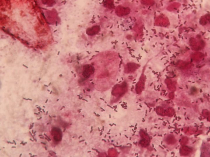 Numerous leukocytes and bacteria in the smear