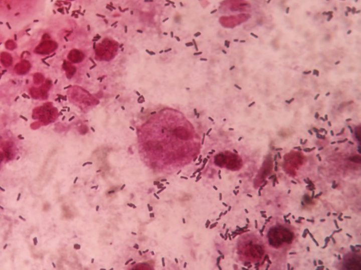 A trichomonad among leukocytes and rod flora