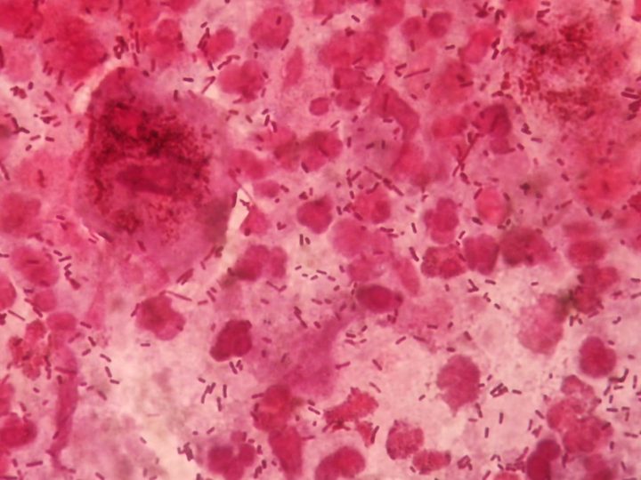 Discharge smear: marked leukocyte reaction
