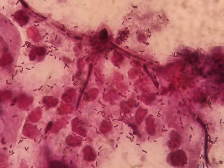 Candida mycelium in a vaginal discharge smear