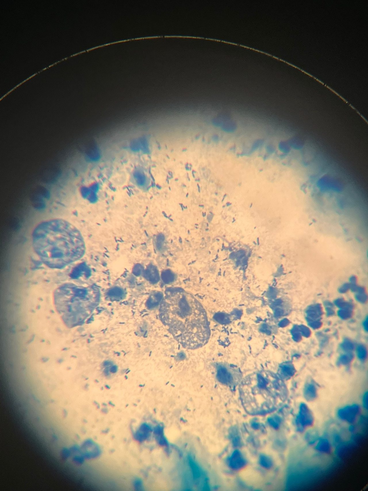 Trichomonads in a smear from an adolescent girl