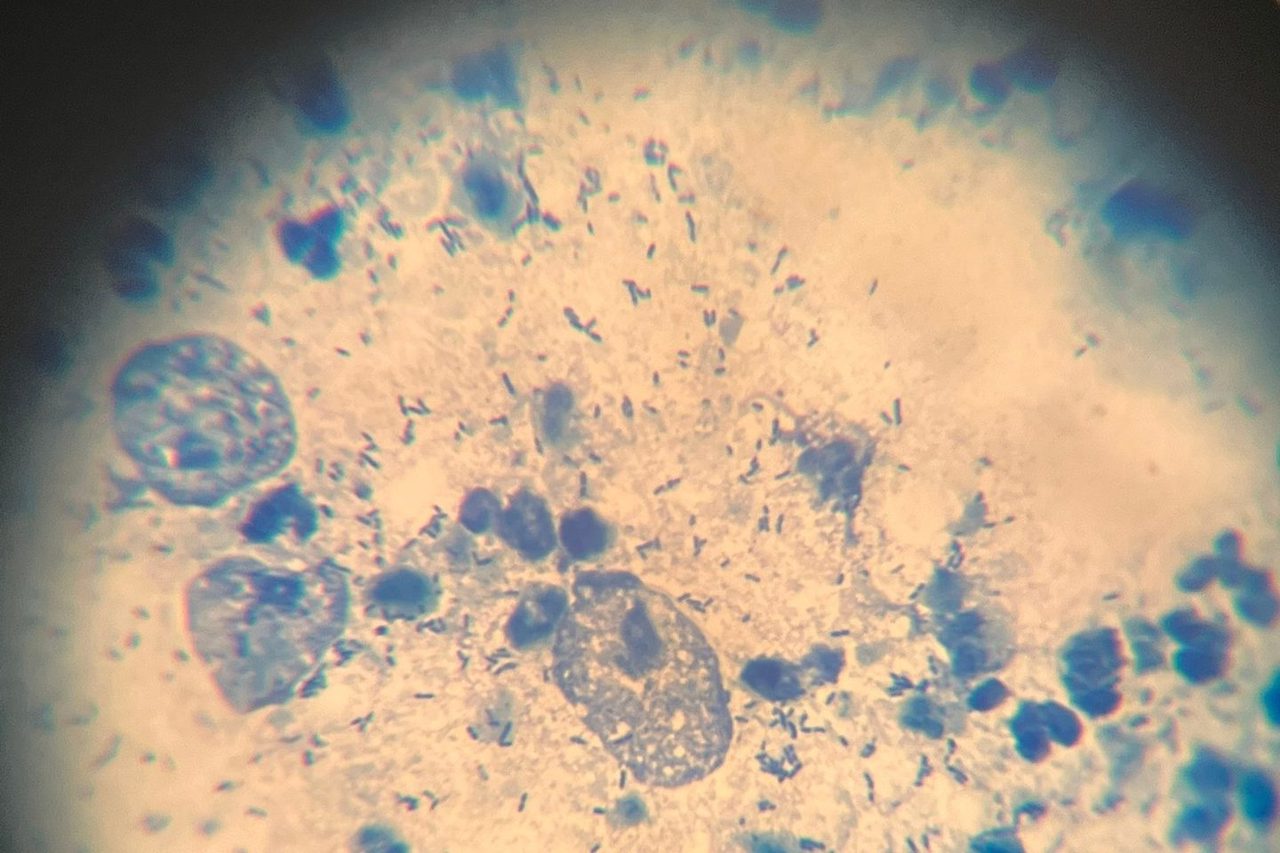 Trichomonads in Urine of an Adolescent Girl: A Case Study