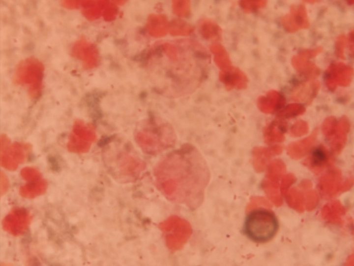 Мазок отделяемого: скопления нейтрофилов и трофозоиты Trichomonas vaginalis