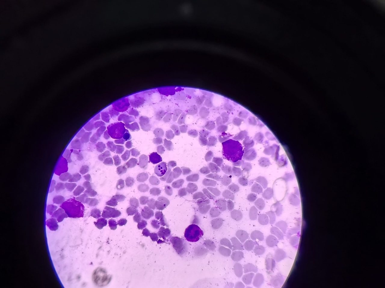 Platelets on Erythrocytes in Bone Marrow Smear
