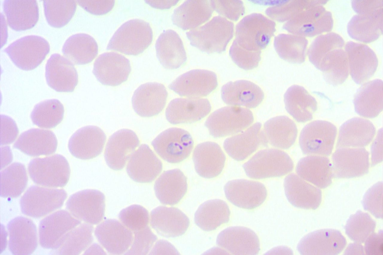Plasmodium falciparum Tropical Malaria in Blood Smear
