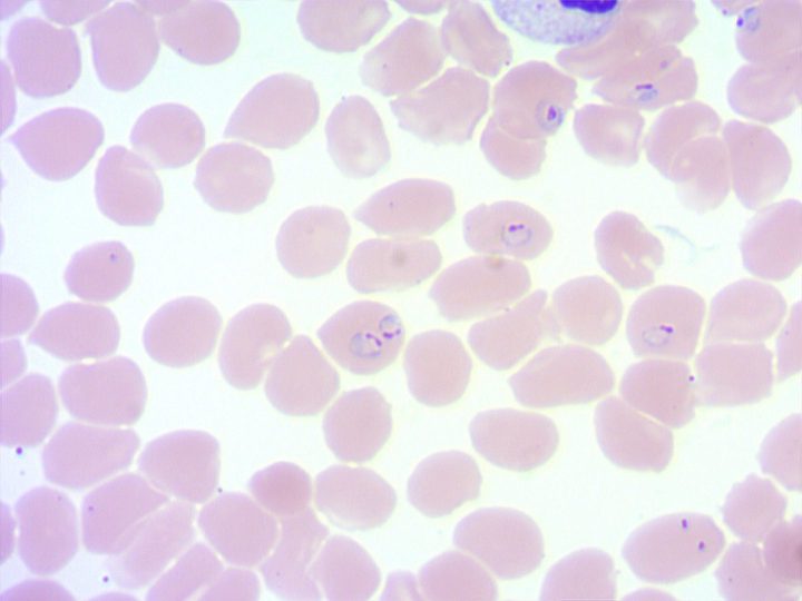 Blood smear: multiple ring-form trophozoites of Plasmodium falciparum