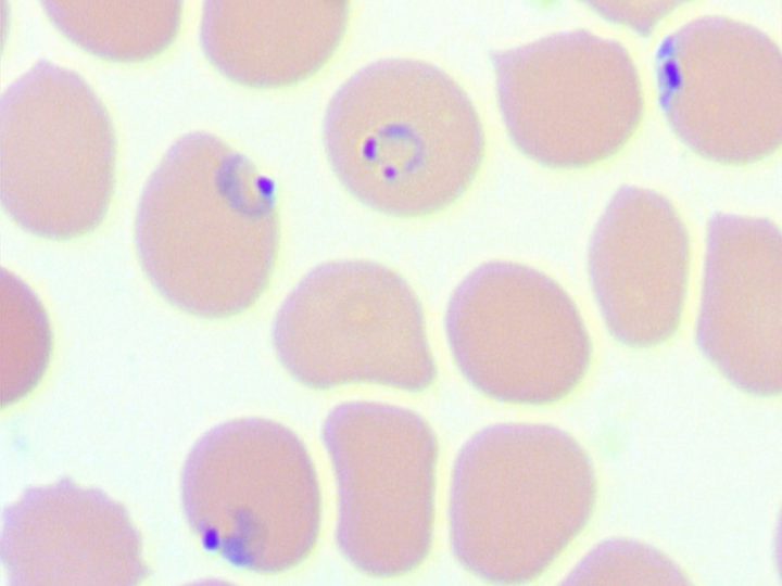 Blood smear: small ring-form trophozoites of P. falciparum with a punctate nucleus