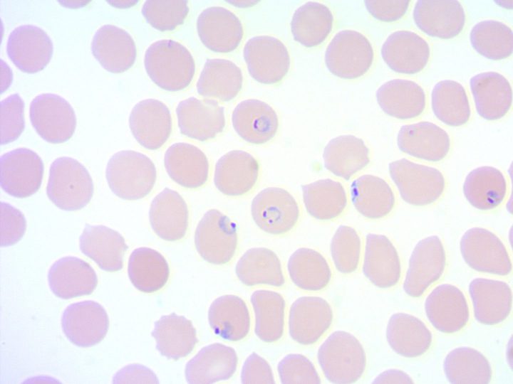 Blood smear: normal-sized erythrocytes with ring-form trophozoites