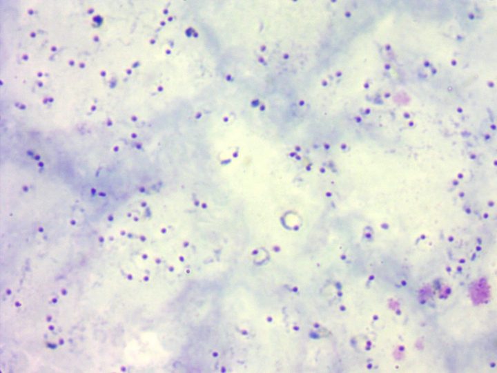 Thick film: high parasitemia with Plasmodium falciparum trophozoites