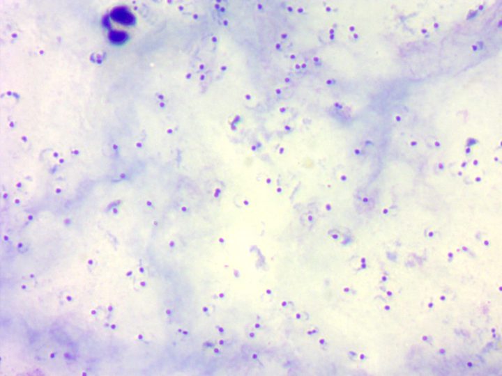 Thick film: numerous Plasmodium rings and a neutrophil