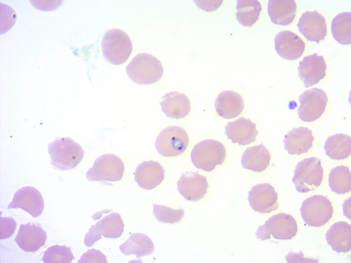 Blood smear: characteristic ring-form trophozoite of Plasmodium falciparum
