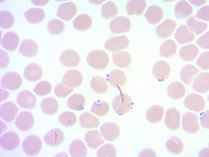 Blood smear: multiple invasion of an erythrocyte by two trophozoites