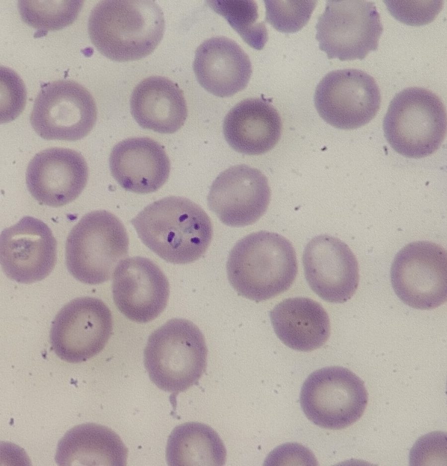 Тропическая малярия Plasmodium falciparum в мазке крови