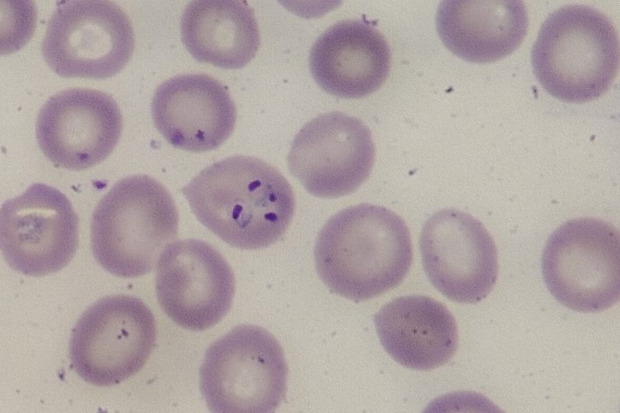 Тропическая малярия Plasmodium falciparum в мазке крови