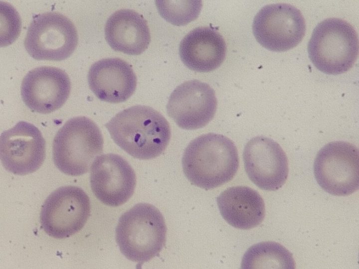Мазок крови, эритроцит с множественной инвазией трофозоитами Plasmodium falciparum