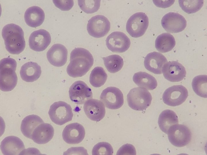 Мазок крови, кольцевидные трофозоиты Plasmodium falciparum в эритроцитах