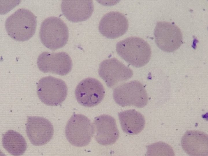 Мазок крови, эритроцит с двумя кольцевидными трофозоитами Plasmodium falciparum