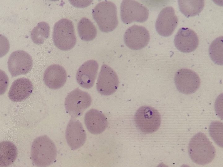 Мазок крови, тонкие кольцевидные трофозоиты Plasmodium falciparum