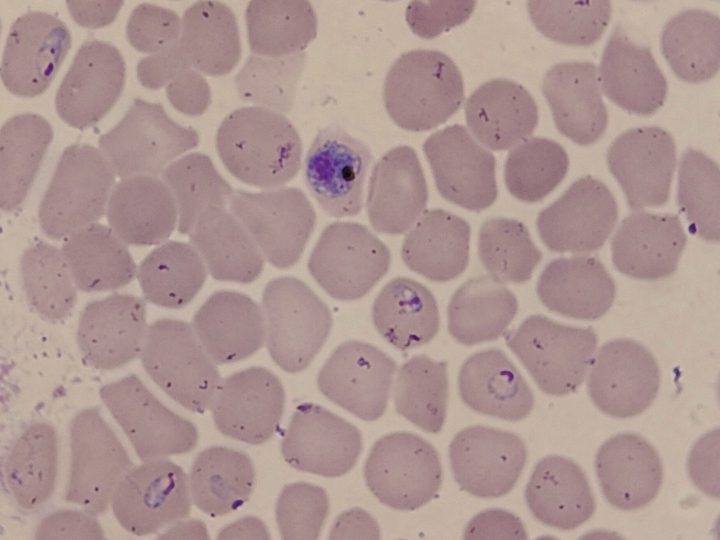 Мазок крови, шизонт Plasmodium falciparum с глыбками пигмента и кольца