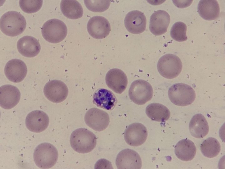 Мазок крови, созревающий шизонт Plasmodium falciparum с гемозоином
