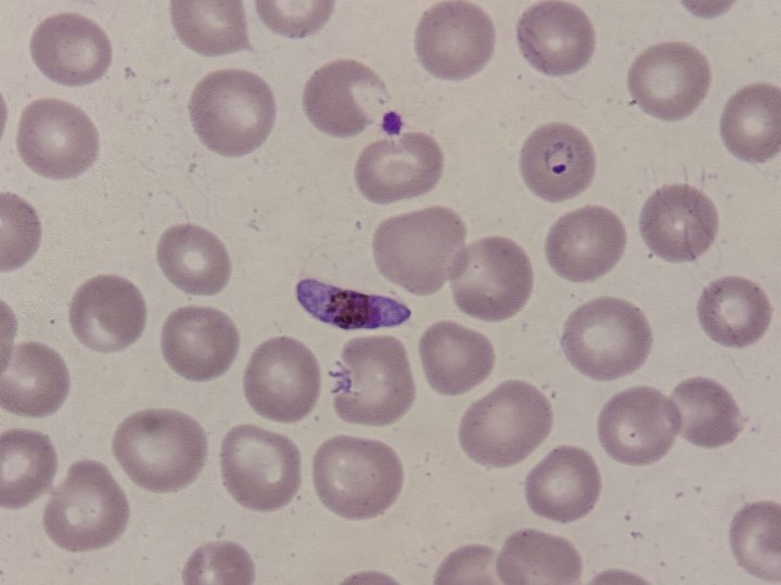 Мазок крови, характерный полулунный гаметоцит Plasmodium falciparum