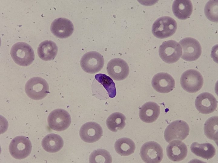 Мазок крови, серповидный гаметоцит Plasmodium falciparum с пигментом