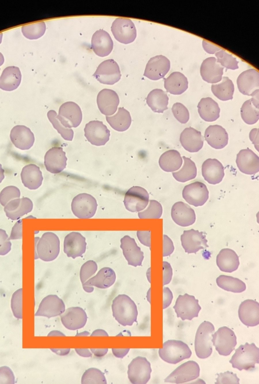 Tropical Malaria in Blood Smear: A Clinical Case