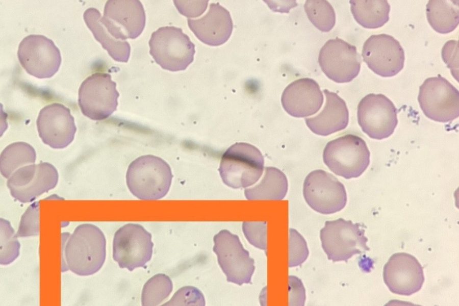 Tropical Malaria in Blood Smear: A Clinical Case