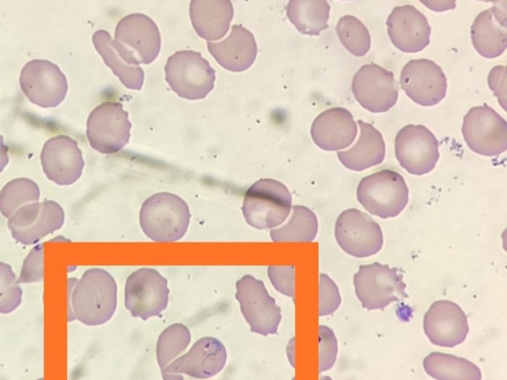 Blood smear: ring-form trophozoite of Plasmodium falciparum in an erythrocyte