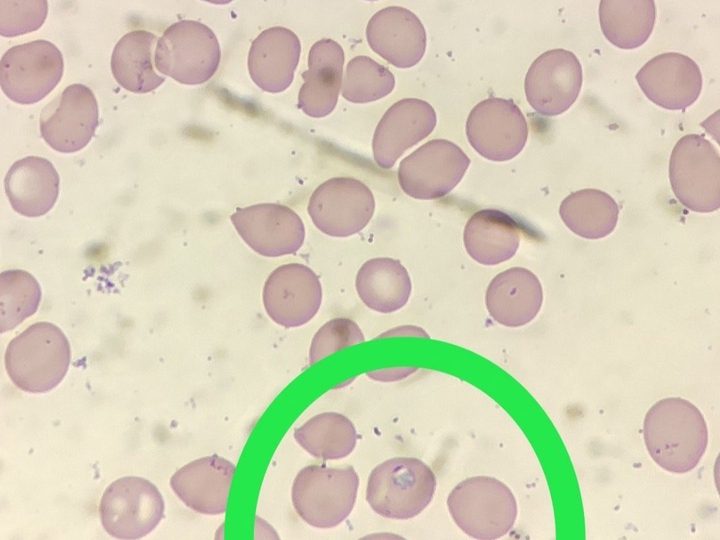 Blood smear: malaria plasmodium trophozoite inside an erythrocyte