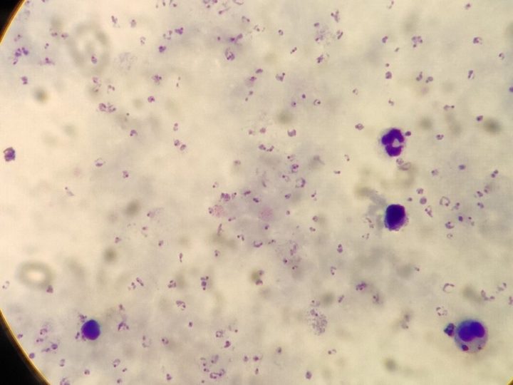 Thick blood film preparation: “starry sky” appearance with plasmodia