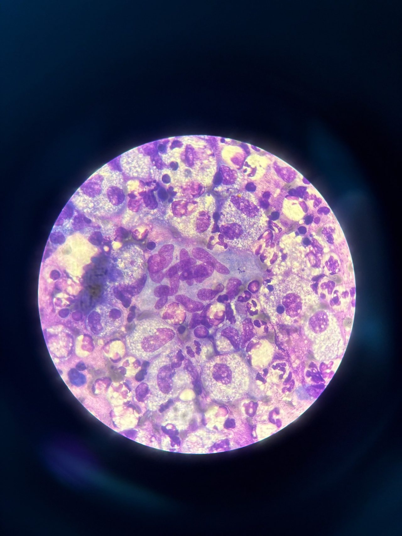 Tuberculous Lymphadenitis: Lymph Node Imprint Cytology