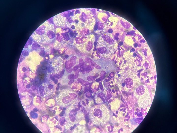 Lymph node imprint: cluster of epithelioid cells against a background of cellular debris